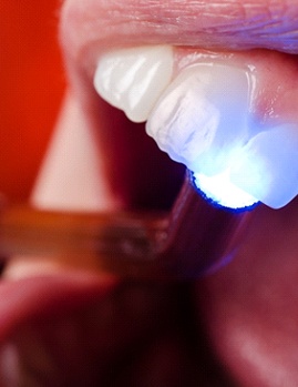 Dental bonding treating front tooth