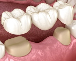 Digital illustration of a dental bridge in Dallas