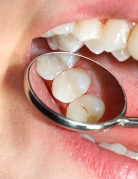 Closeup of a dental crown in Dallas