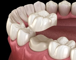 Digital illustration of a dental crown in Dallas being placed