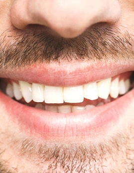 Man with a chipped tooth needing dental bonding in Dallas