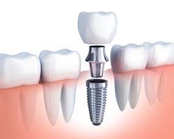 Diagram of dental implant sin Dallas, GA