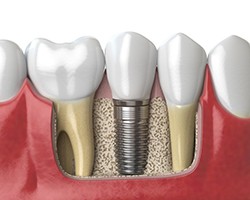 Diagram of how dental implants work in Dallas, GA 