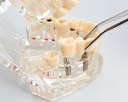 Dallas, GA implant dentist placing final restoration on model