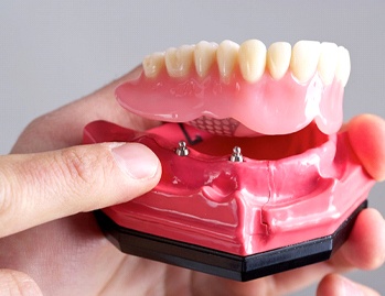 hand holding implant-retained dentures