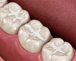 a 3 D illustration of tooth colored fillings