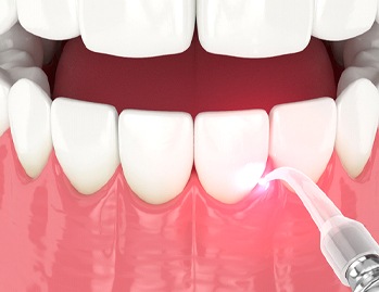 A digital image of a soft tissue laser performing work on a patient’s smile