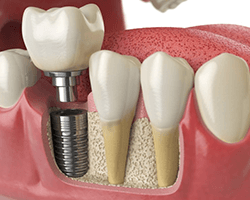 a woman holding cheek due to failed dental implant