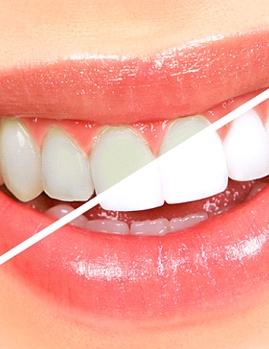 A before and after image of a person who received teeth whitening treatment in Dallas