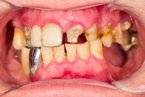 damaged, decayed teeth