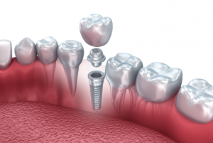 Model of dental implant