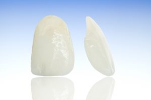 Front and side view of a porcelain veneer