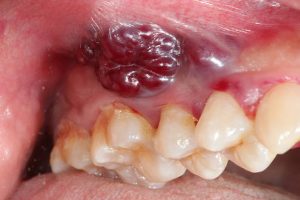 Patient with oral cancer