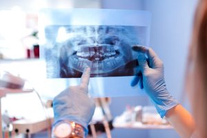 Dentist wearing blue gloves holding up an x-ray with her right hand and pointing to it with her left pointer finger