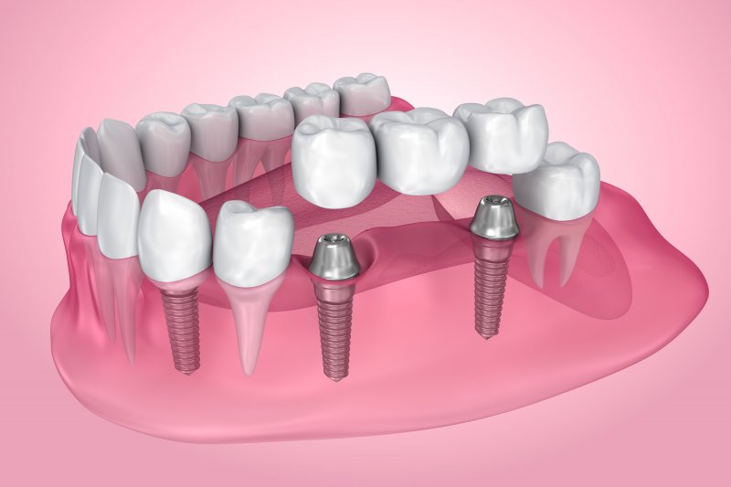 Exploded illustration of dental implants with bridge