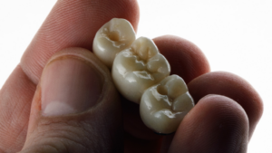 a close-up of a dental bridge